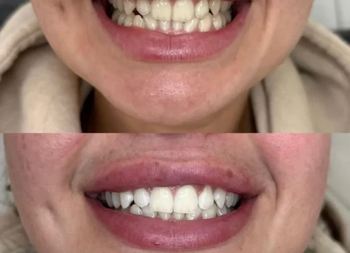 What Are the Disadvantages of Teeth Whitening
