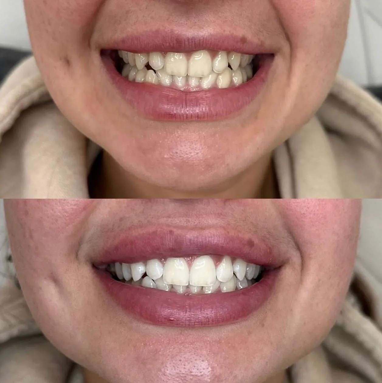 What Are the Disadvantages of Teeth Whitening?